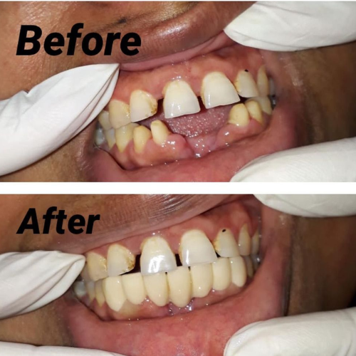 dental result