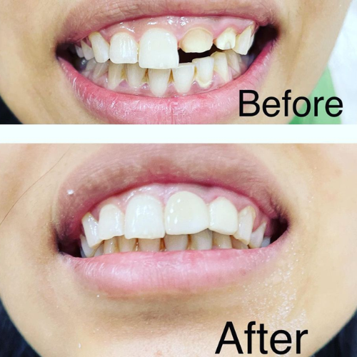 dental result