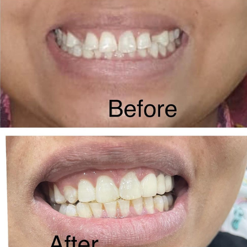 dental result