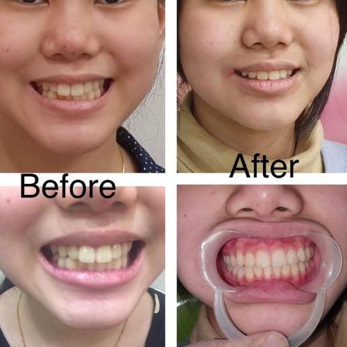 dental result