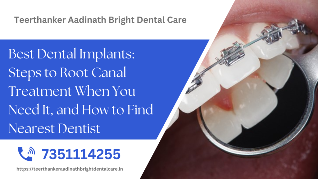 Best Dental Implants