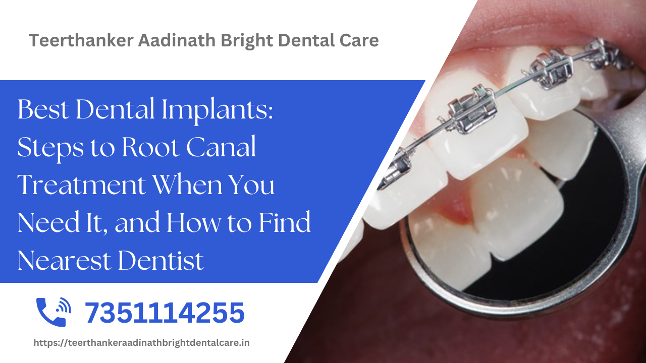 Best Dental Implants